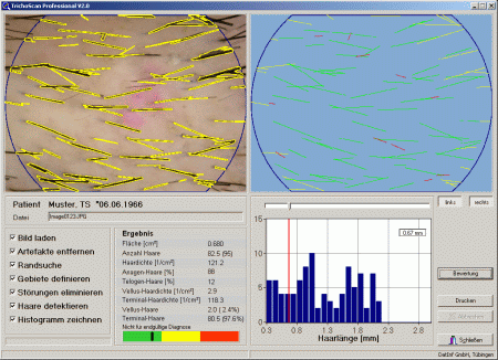 Screenshot von TrichoScan mit einem ausgewerteten Bild. Mit freundlicher Genehmigung von Priv. Doz. Dr. Rolf Hoffmann