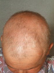 Therapie Alopecia Areata